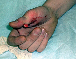 Skier thumb - common ski injury